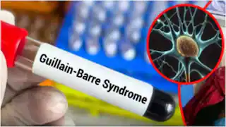 తెలంగాణలో తొలి గులియన్‌ బారే సిండ్రోమ్‌ కేసు… ప్రజలకు అప్రమత్తంగా ఉండాలని వైద్యులు సూచన….